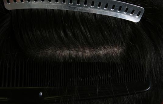 Hair Transplant&nbsp;Trichophytic Donor Scars